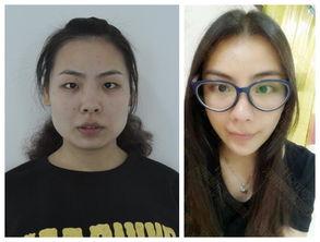 打国产瘦脸针视频,跟随视频学习安全瘦脸技巧